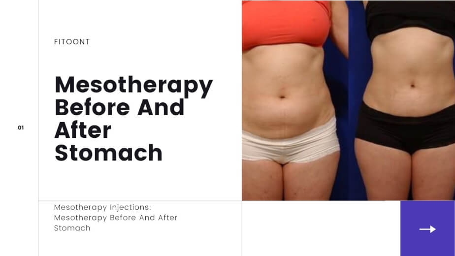 Mesotherapy Injections: Mesotherapy Before And After Stomach - Fitoont