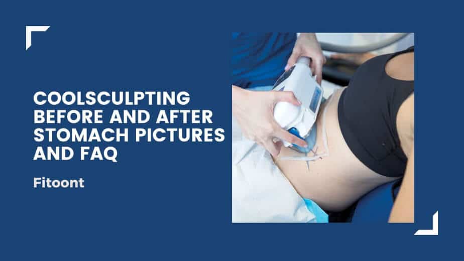 coolsculpting treatment, coolsculpting sessions, coolsculpting before and after stomach pictures,fitoont