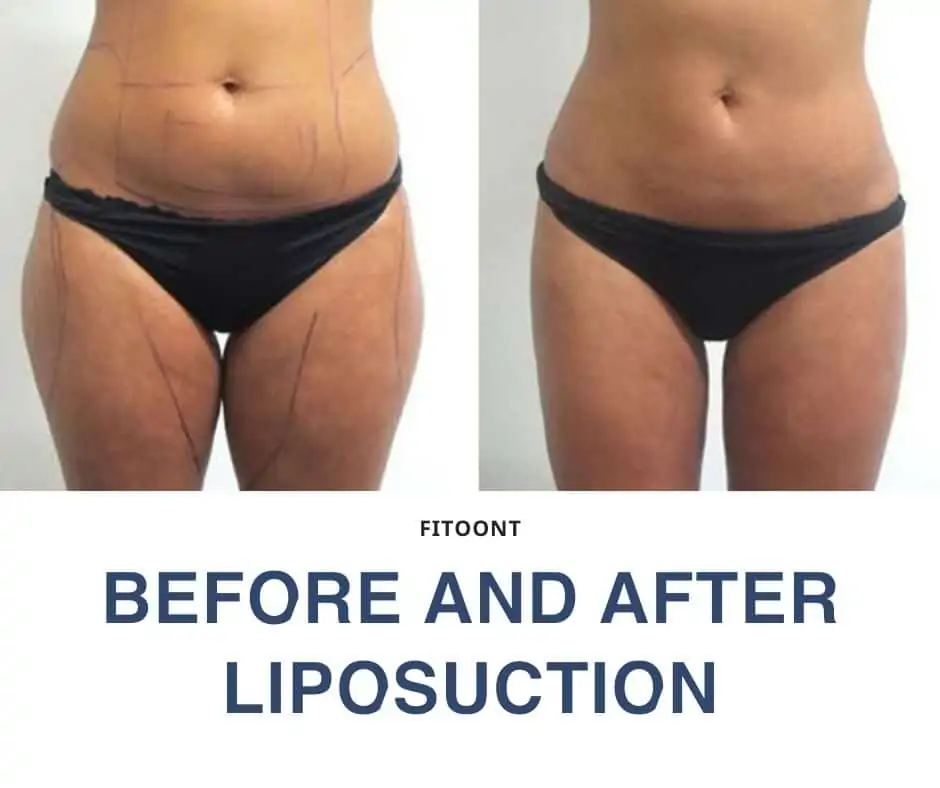 Before and after Liposuction