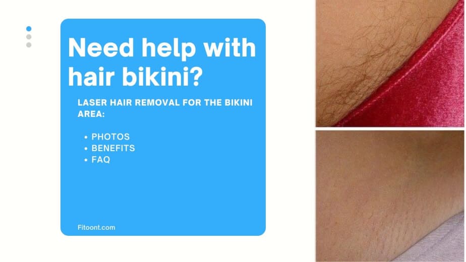 before and after laser hair removal bikini, laser hair removal bikini, laser hair removal, Bikini laser hair removal, new york city laser hair removal