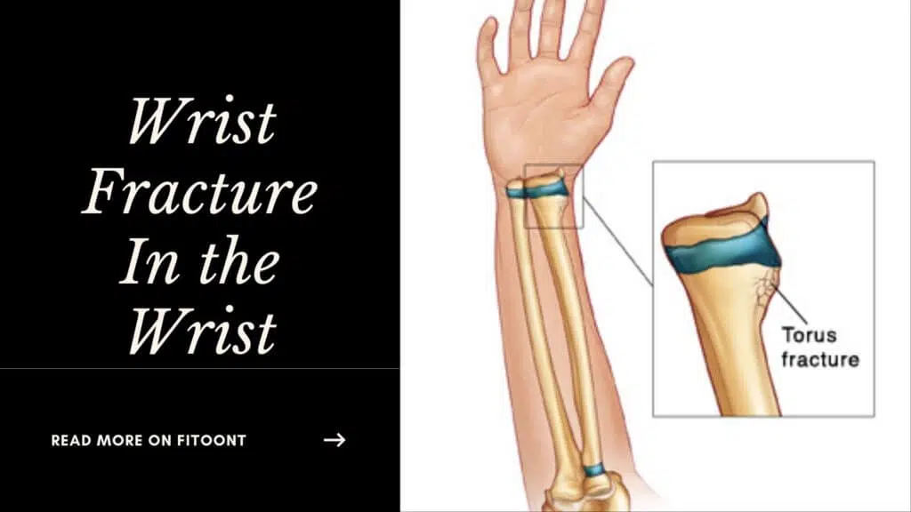 buckle fracture in the wrist, buckle fracture wrist symptoms