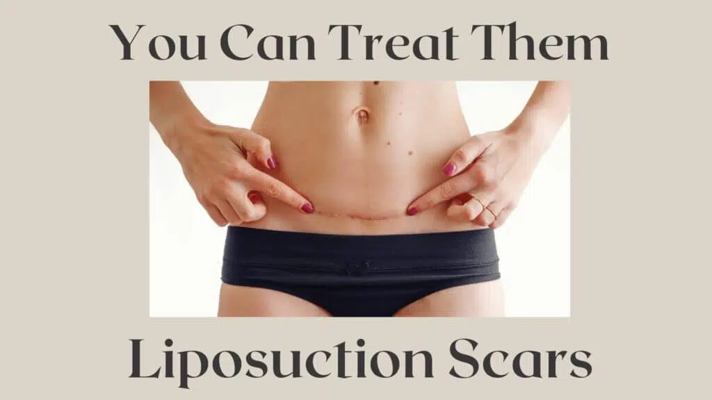 liposuction scars