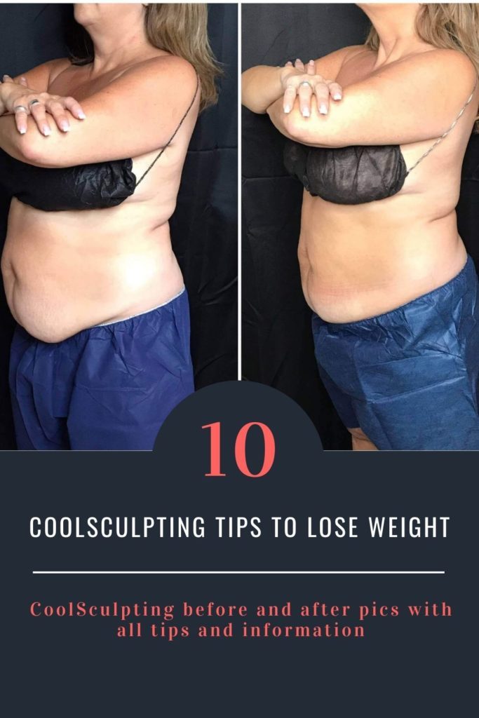 coolsculpting before and after pics