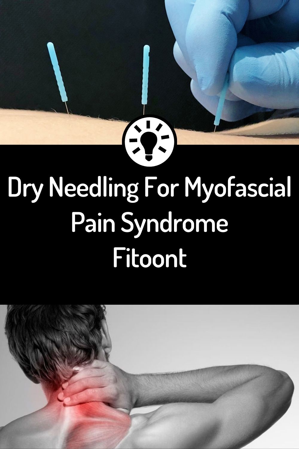 dry needling dry needling, dry needles dry needles, myofascial pain syndrome myofascial pain syndrome, myofascial trigger points myofascial trigger points, trigger points trigger points