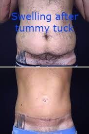 swelling after tummy tuck