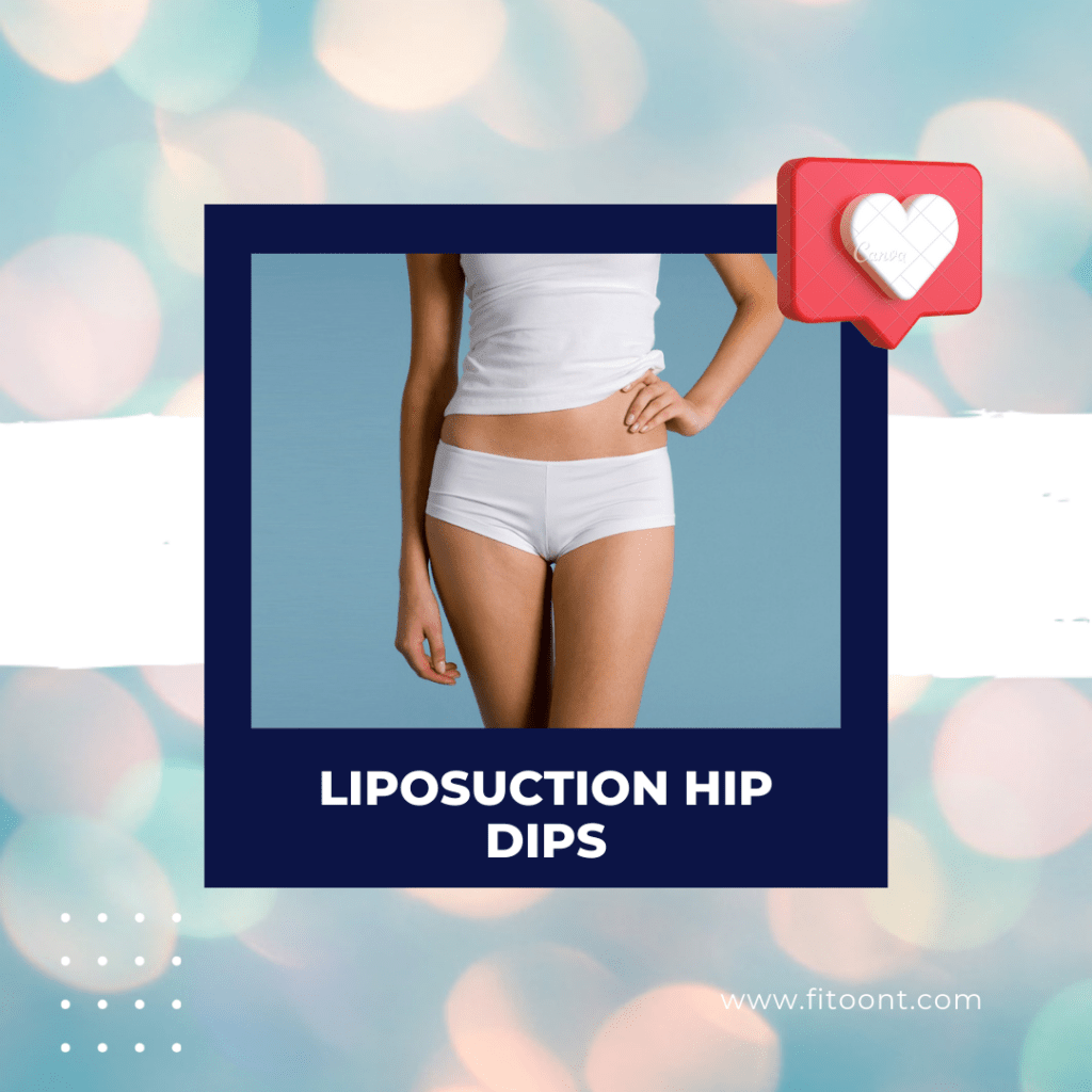 Liposuction hip dips