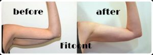 vaser liposuction arm before and after