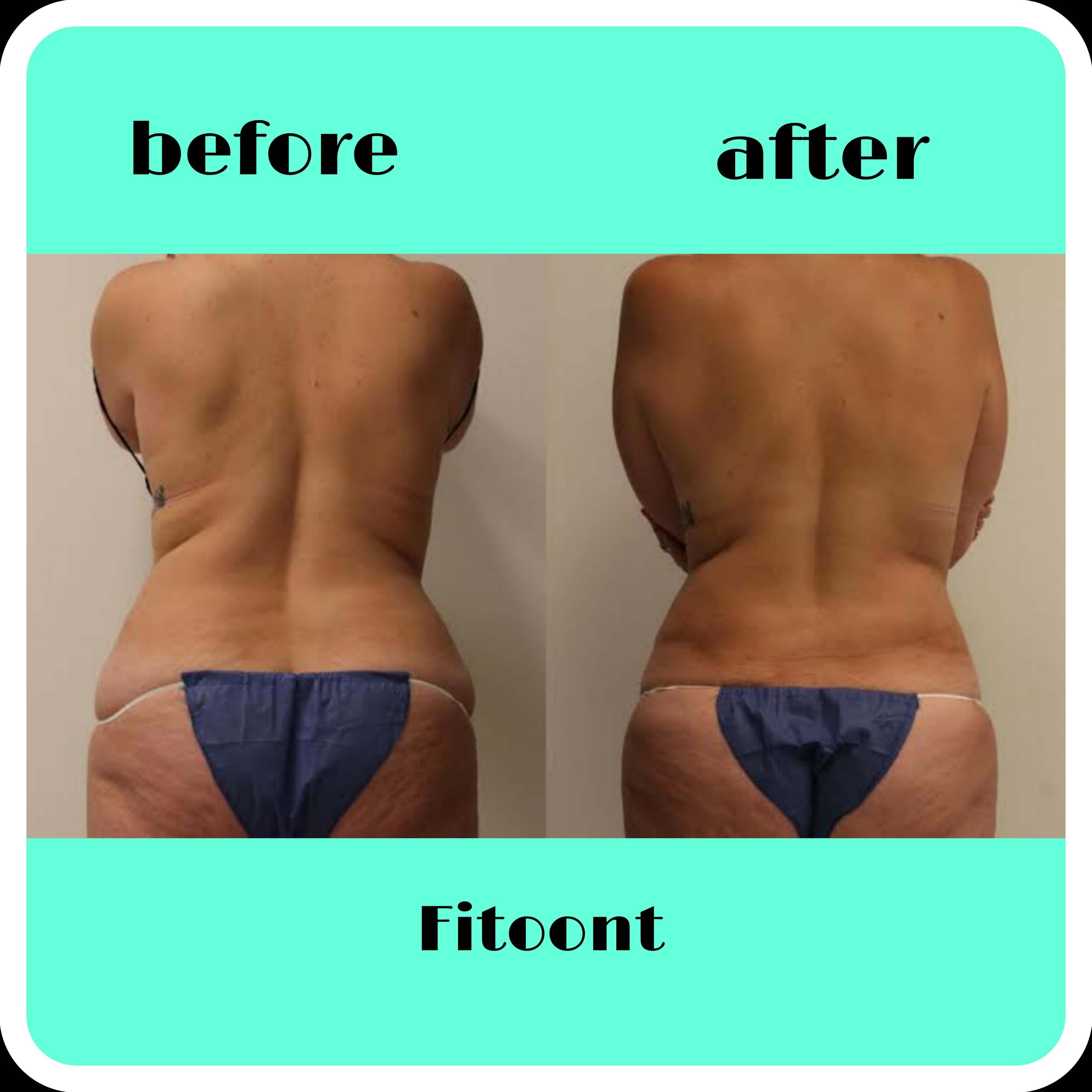 vaser liposuction flanks before and after