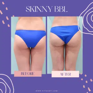 Skinny BBl before and after pics