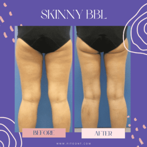 Skinny BBl with liposuction