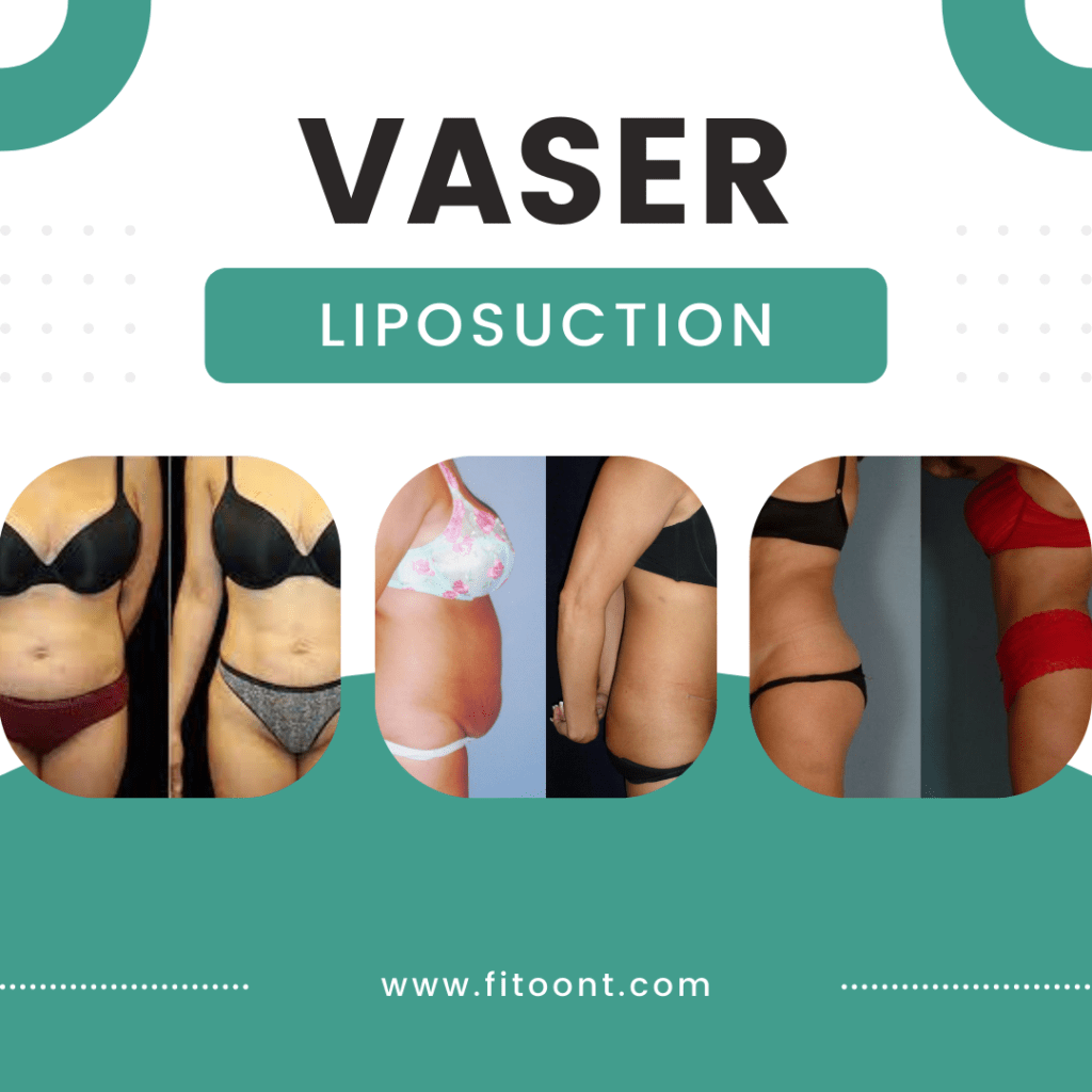 vaser lipo before and after