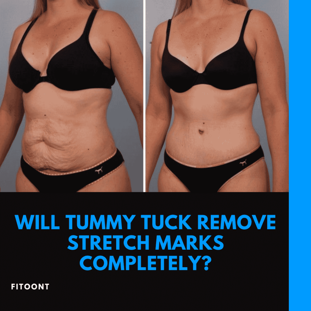 will a tummy tuck remove stretch marks