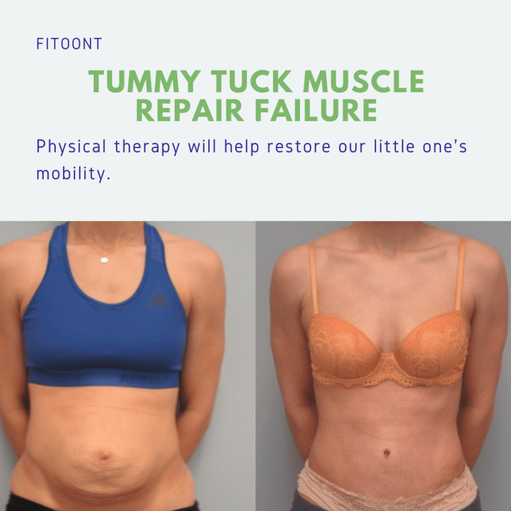 tummy tuck muscle repair failure