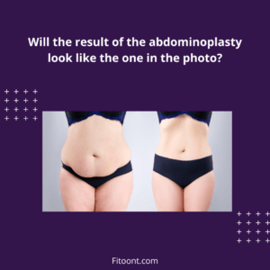 tummy tuck before and after male