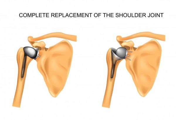 shoulder arthroplasty protocol